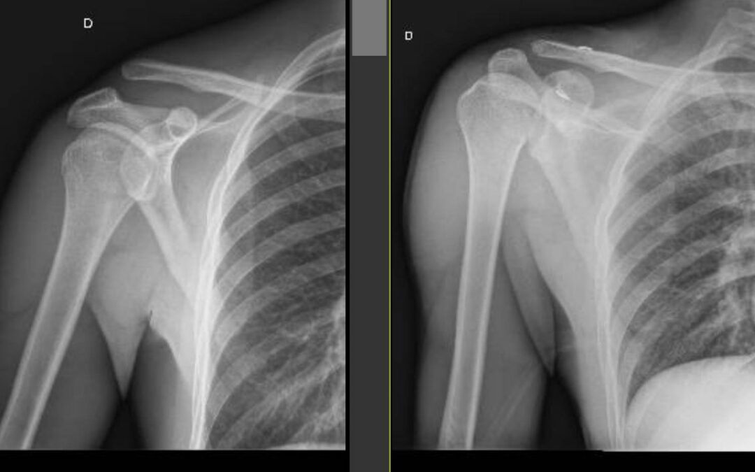 Lussazione acromion-claveare tipo 3B: intervento riuscito!