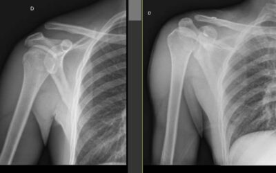 Lussazione acromion-claveare tipo 3B: intervento riuscito!