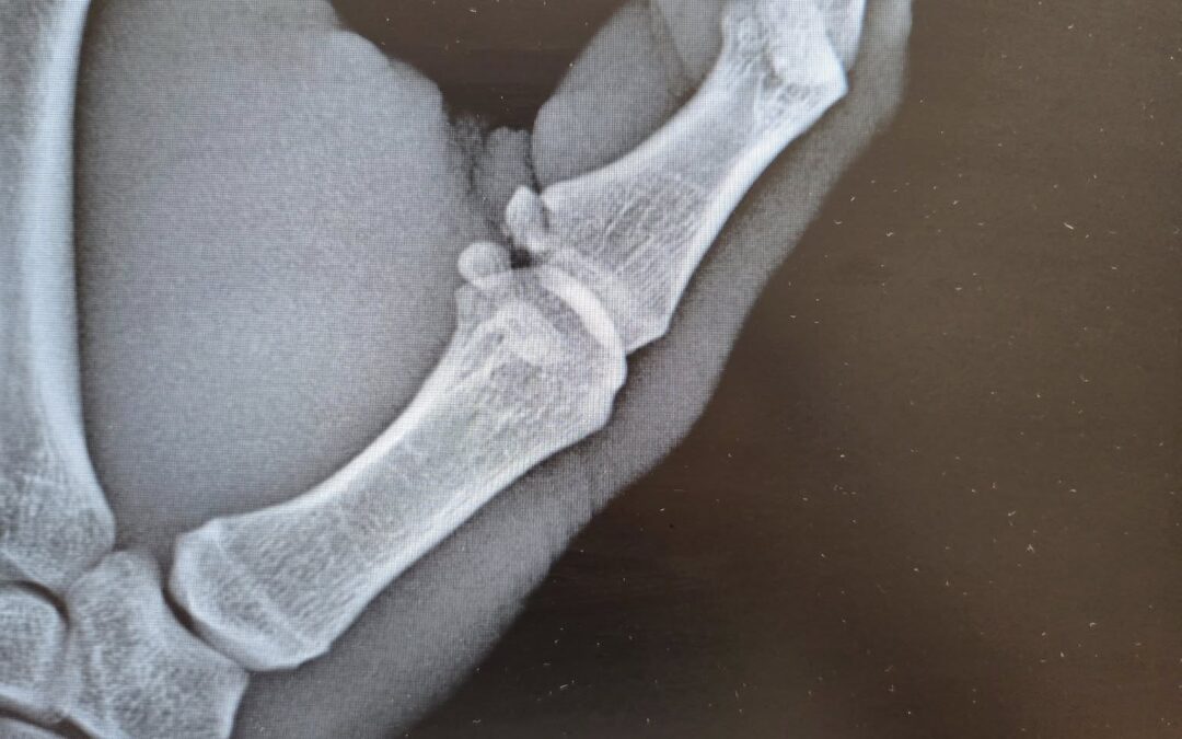 Lesione di Stener in un atleta professionista di baseball