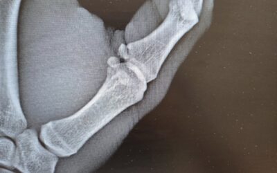 Lesione di Stener in un atleta professionista di baseball